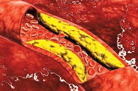 ارتفاع الكوليسترول الضار.. مخاطر يجب الانتباه إليها 