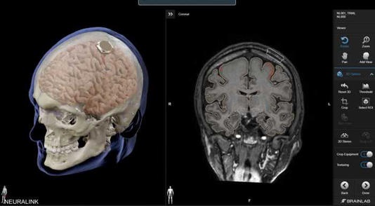 إيلون ماسك يعلن نجاح زرع شريحة دماغية في أول إنسان.. هذه مميزاتها