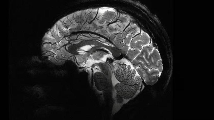 جهاز تصوير بالرنين المغناطيسي يلتقط أول فحوصات دماغية دقيقة للغاية