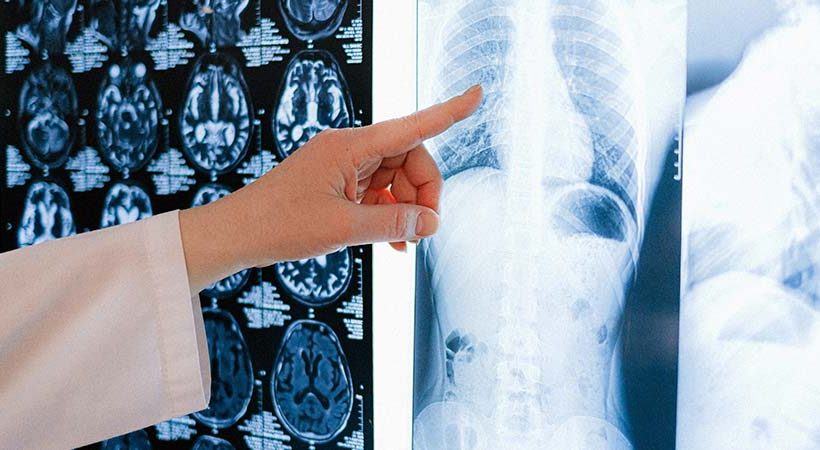 أمل جديد لمرضى سرطان العظام.. علاج مناعي يُظهر نتائج واعدة