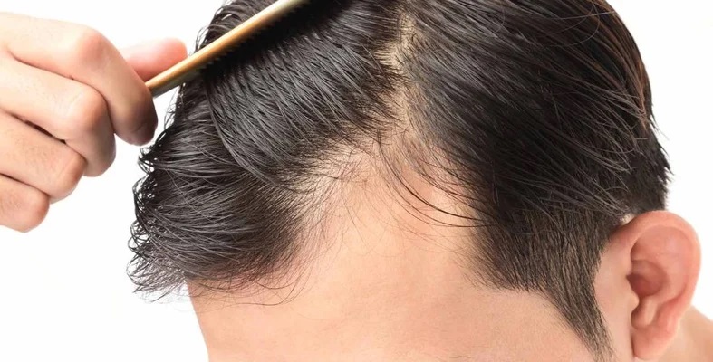 دراسة صينية تحذر: استهلاك المشروبات السكرية يسبب تساقط الشعر