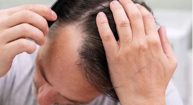 سكر طبيعي في الجسم قد يكون علاجًا للصلع الوراثي.. دراسة تكشف نتائج واعدة