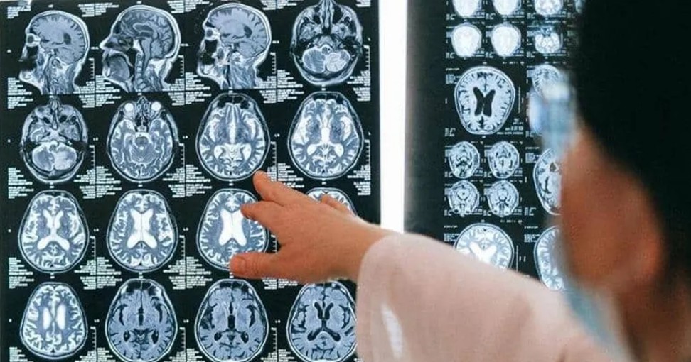 الأجيال الجديدة أقل عرضة للإصابة بالخرف