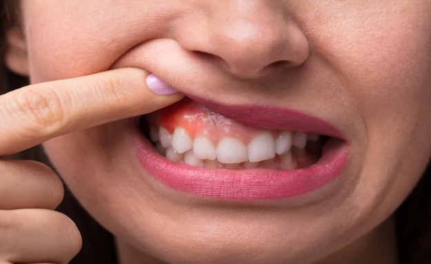 اكتشاف واعد لعلاج التهابات اللثة دون مضادات حيوية