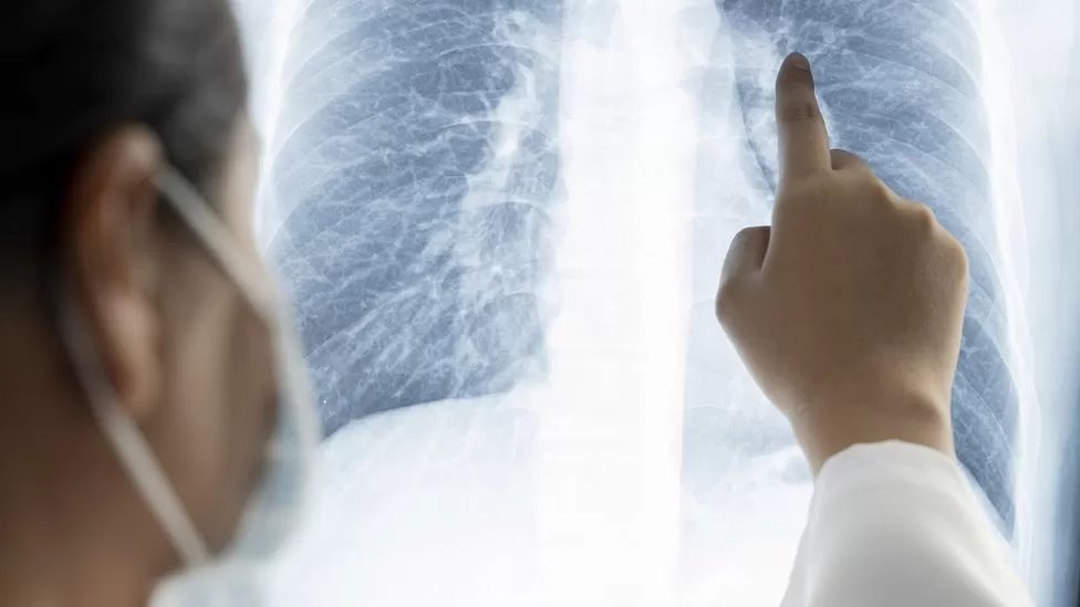 السرطان قد يتخفى خلف أمراض شائعة.. علامات يجب الانتباه لها