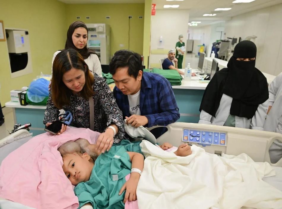 بدء عملية فصل التوأم الملتصق الفلبيني «كليا وموريس آن» في الرياض 