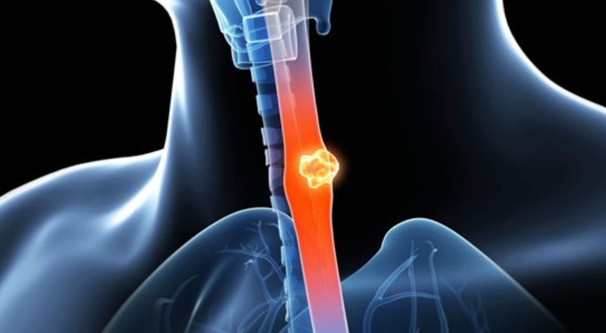 علامة صامتة قد تنذر بسرطان المريء